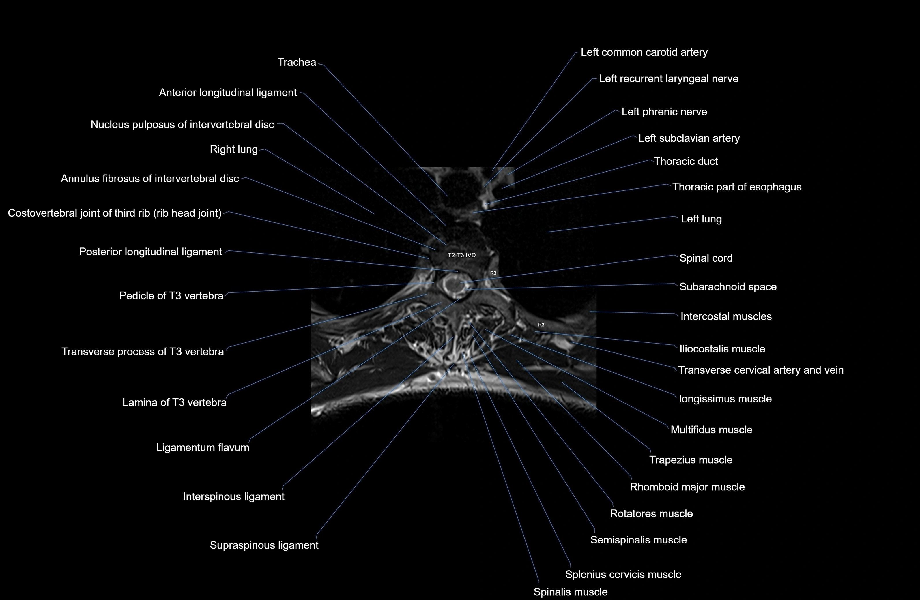 MRI thoracic spine axial  cross sectional anatomy 3T radiology  image-img-00001-00019.webp